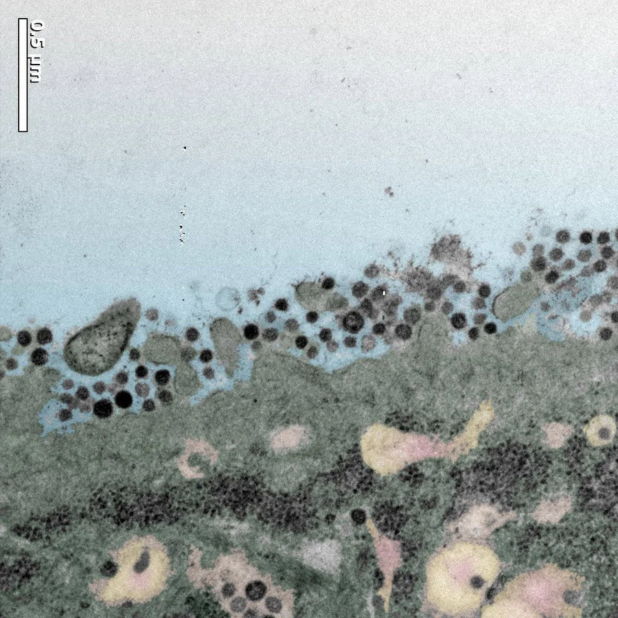 An electron microscope picture shows that the cells from human bronchial tissue can be infected by MERS-CoV and the MERS-CoV can replicate in human respiratory tissues.