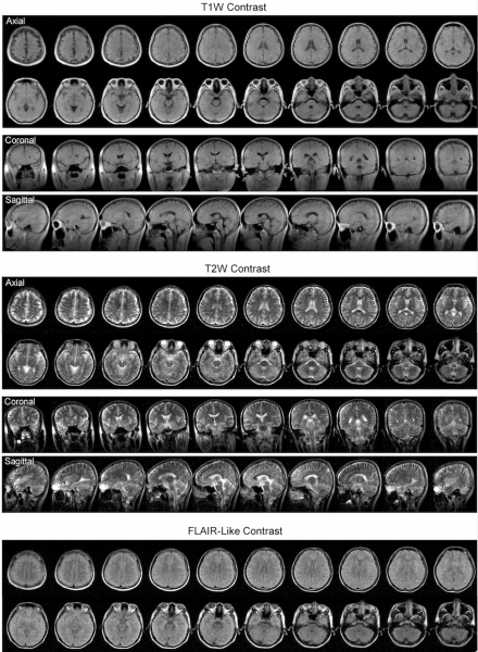 MRI images of a normal human subject produced at 0.055 Telsa  