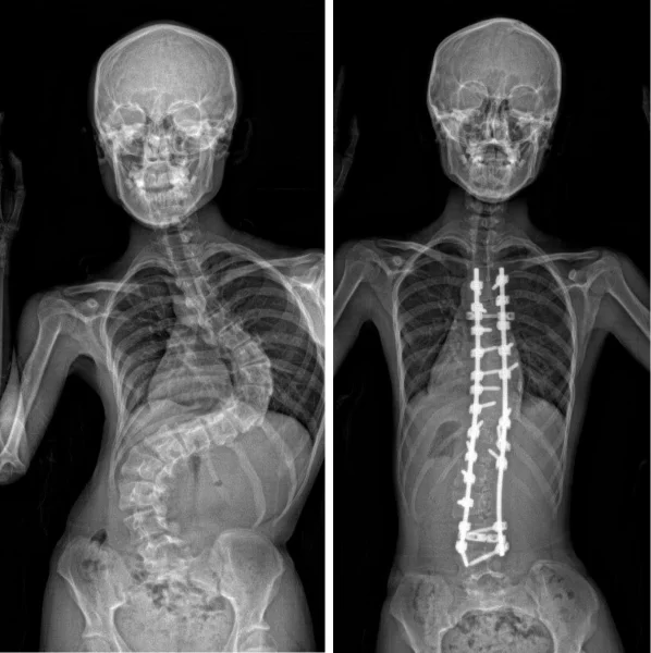 Currently, the treatment options for AIS are limited to bracing and invasive surgery once the condition has developed. The x-ray photos depict an AIS patient before (left) and after surgery.  