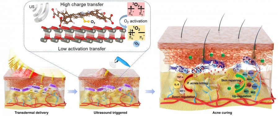 Treatment of acne through efficient ultrasound-triggered antibacterial nanoparticles embedded microneedle patch.  