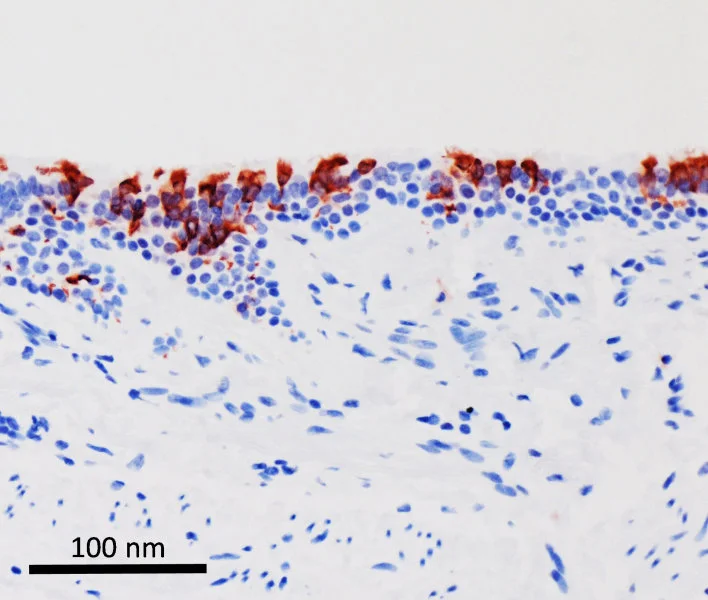 Omicron variant of SARS-CoV-2 (in red) infected human bronchus tissues.   