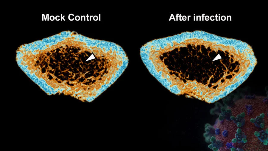 SARS-CoV-2 infection induces continuous inflammatory bone loss during both the acute and post-recovery phases of COVID-19. The 3D reconstructed micro-CT scans reveal that the bone trabecula (white arrow) density in the femur of SARS-CoV-2-infected hamsters (Right) is significantly lower than that of the Mock control (Left).  
