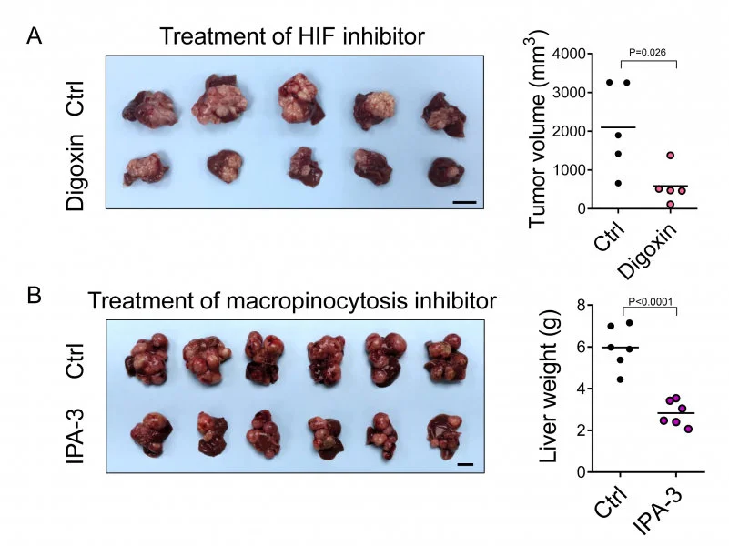 HKUMed discovers a new metabolic route for liver cancer  paving the way for new therapeutic opportunities 