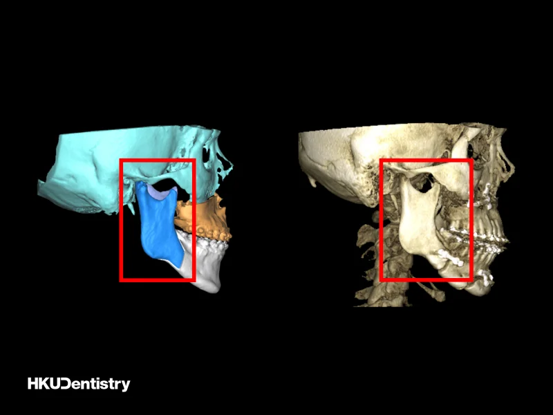 Sagittal split ramus osteotomy (SSRO): (Left) The pre-operative virtual surgical planning (red frame); (Right) The post-operative CT scan showing the fixation with titanium plate and screws (red frame).  