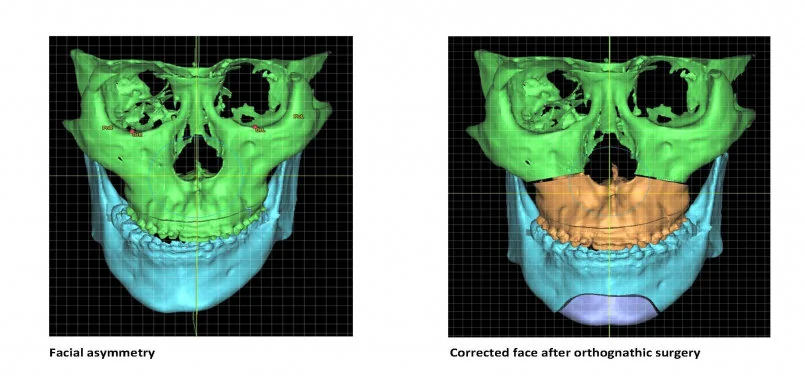 HKU Dentistry study finds facial asymmetry correction surgery effective 
in relieving syndrome of jaw joint pain patients