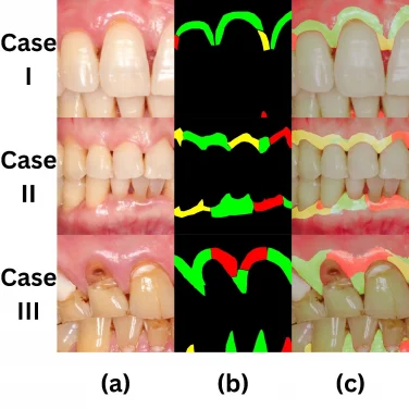 HKU Dentistry team uses artificial intelligence for early detection of gum inflammation