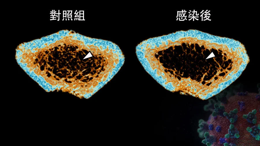 SARS-CoV-2 infection induces continuous inflammatory bone loss during both the acute and post-recovery phases of COVID-19. The 3D reconstructed micro-CT scans reveal that the bone trabecula (white arrow) density in the femur of SARS-CoV-2-infected hamsters (Right) is significantly lower than that of the Mock control (Left).  