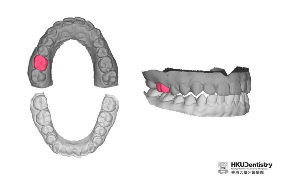 Photo 2: The research team uses 3D GAN to learn the relationship of teeth in a dental arch on the 175 student participants. After training, 3D GAN is able to generate a tooth (red) based on the feature of remaining teeth (dark grey). Research team proposes further investigate the presence of opposing teeth helps the AI to generate a more natural tooth (red).  