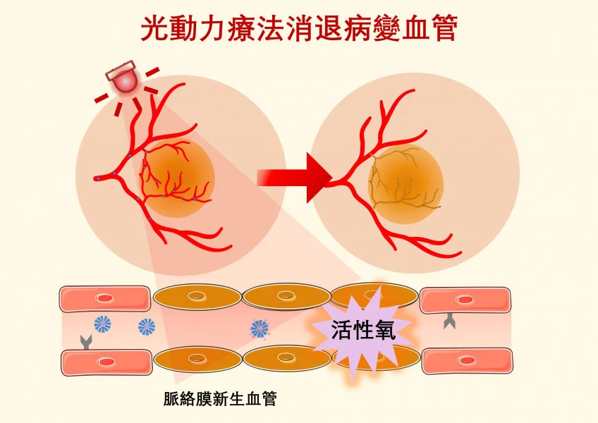 Photodynamic therapy (PDT) offers a clinical solution by utilising non-toxic photosensitisers activated by specific wavelengths of light to generate reactive oxygen species (ROS), which can damage and obliterate neovascularisation.   