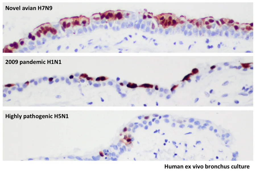 The image shows human ex vivo bronchus culture, research team compared the extent of virus infection with the avian influenza A (H7N9) virus, the 2009 pandemic influenza A (H1N1) virus (commonly known as swine influenza) and highly pathogenic avian influenza A (H5N1) virus in the human bronchus tissues cultured ex vivo. The part with brown color shows virus infected cells and the blue indicates non infected cells. H7N9 virus leads to extensive infection of the surface cells (epithelium) of the bronchus, comparable to the 2009 pandemic virus.  In contrast, the H5N1 virus only infects occasional bronchial epithelial (surface) cells.