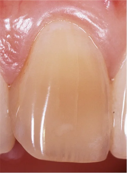 Public Warned about Tooth Fractures from Snacking On Seeds and Nuts during Chinese Lunar New Year