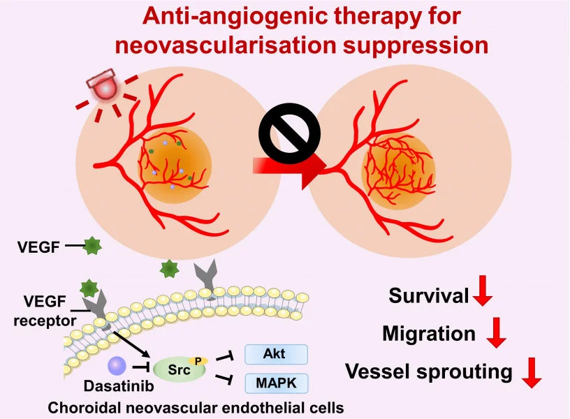Anti-angiogenic therapy suppresses choroidal neovascularisation (CNV) by inhibiting vascular endothelial growth factor (VEGF)-related pathways. The study represents the first attempt at integrating a photoactivatable anti-angiogenic agent with a photosensitiser into a single nanoformulation for age-related macular degeneration treatment, which opens up new avenues for the development of minimally-invasive therapeutics for AMD and other neovascular ocular disorders.  