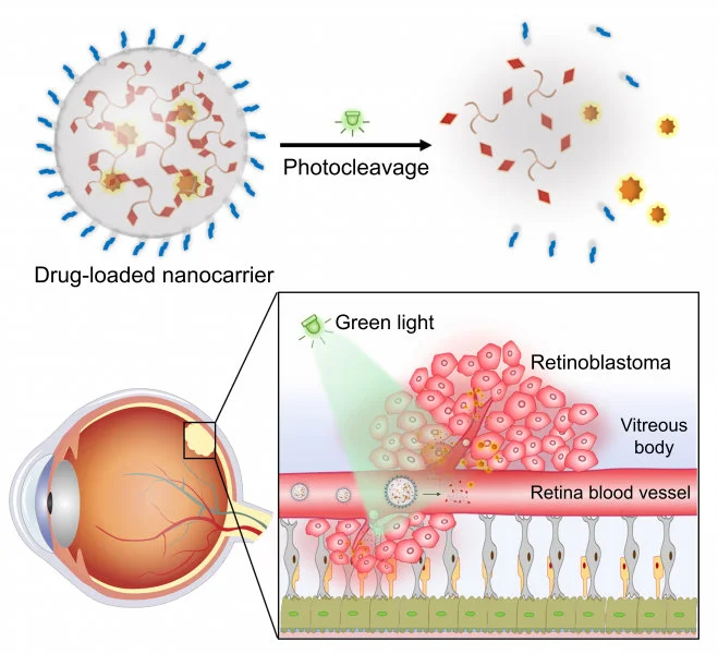 The research team developed a green light-responsive nanocarrier based on the self-assembly of photocleavable three-legged molecules. After intravenous injection of drug-loaded nanocarriers, the light-triggered drug release in retinoblastoma exhibited significant anticancer efficacy and minimal side effects.  