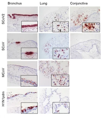 HKUMed researchers discovered novel coronavirus (SARS-CoV-2) can infect more efficiently than SARS-CoV in human airways and eyes, 
  implicating that eyes may be an important route of SARS-CoV-2 human infection