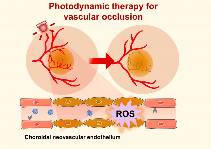 Photodynamic therapy (PDT) offers a clinical solution by utilising non-toxic photosensitisers activated by specific wavelengths of light to generate reactive oxygen species (ROS), which can damage and obliterate neovascularisation.  