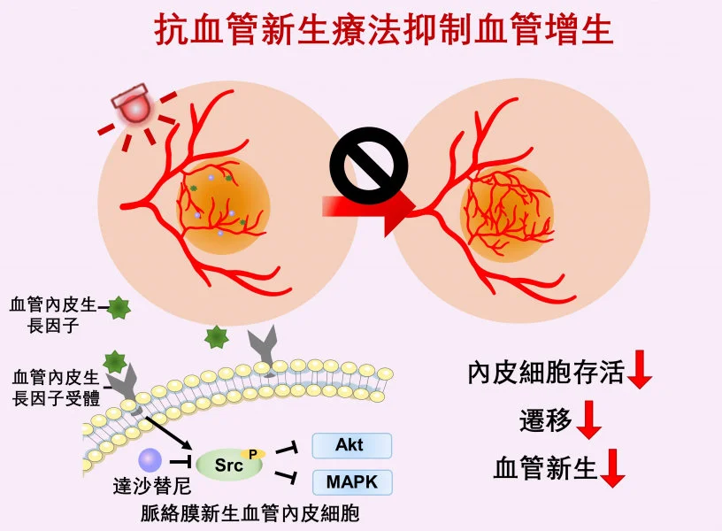 Anti-angiogenic therapy suppresses choroidal neovascularisation (CNV) by inhibiting vascular endothelial growth factor (VEGF)-related pathways. The study represents the first attempt at integrating a photoactivatable anti-angiogenic agent with a photosensitiser into a single nanoformulation for age-related macular degeneration treatment, which opens up new avenues for the development of minimally-invasive therapeutics for AMD and other neovascular ocular disorders.  