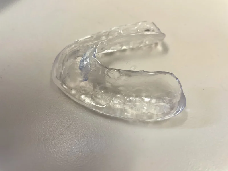 A typical occlusal splint to be worn by the patient at night as a conservative treatment option for temporomandibular disorders.  