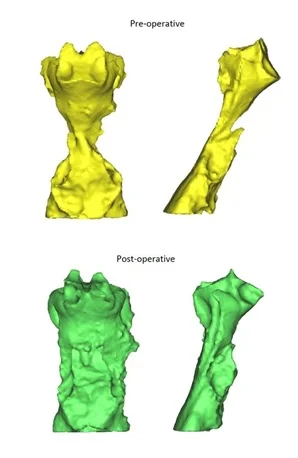 The pre-operative and post-operative airway images, showing a significant increase in the airway volume after SMA.  