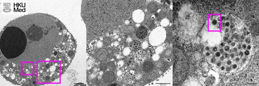 (Left) Low magnification electron micrograph of a Vero (monkey kidney) cell 24 hours after infection with the Omicron variant of SARS-CoV-2. The boxes show clusters of viral particles in the cytoplasm. (Centre) High magnification electron micrograph of the larger box in the left panel showing aggregates of viral particles in vesicles and on the surface of the cell. (Right) High magnification electron micrograph of the smaller box in the left panel showing large aggregates of viral particles with spikes (box) in membrane bound vesicles. Photo credit: Professor John Nicholls, Clinical Professor of Department of Pathology, HKUMed; Professors Malik Peiris, Tam Wah-Ching Professor in Medical Science and Chair Professor of Virology, School of Public Health, HKUMed; Professor Leo Poon Lit-man, Professor and Head of Division of Public Health Laboratory Sciences, School of Public Health, HKUMed; and Electron Microscope Unit, HKU. High-resolution version of the image is available at: https://bit.ly/3EPkKTx 