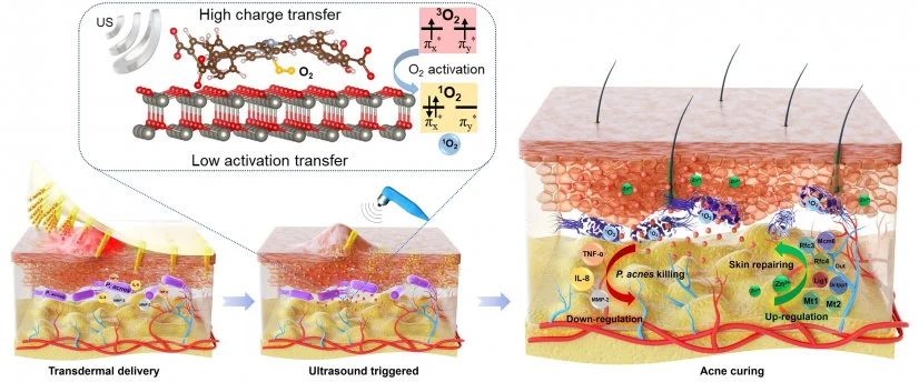 HKUMed invents a novel microneedle array embedded with ultrasound-triggered antibacterial nanoparticles enabling a breakthrough treatment for skin infection