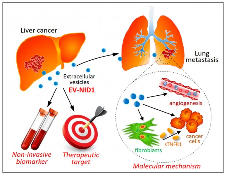 A research team at LKS Faculty of Medicine, The University of Hong Kong (HKUMed) discovered that the liver cancer cell-derived extracellular vesicles (EVs) promote tumour growth and metastasis to lungs. The novel findings of the tumour-derived extracellular vesicles provide insights into promising biomarker and new therapeutic approach for liver cancer.  