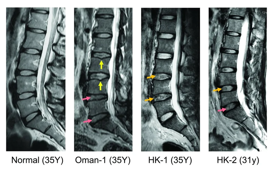 The study result shows that among different populations, LDD cases have been found a genetic variant for an enzyme with them, which is believed to have association with the development of LDD.  In the Hong Kong population, the estimated frequency of the risk variant is 43% for the LDD subjects. The image illustrates the condition of patients with LDD.