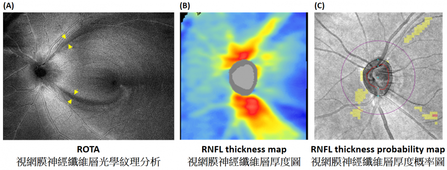 Figure shows superotemporal and inferotemporal retinal nerve fibre layer defects detected by ROTA (yellow arrows) (A) in a patient with early glaucoma that are missed by conventional retinal nerve fibre layer thickness analysis (B and C) – the current clinical standard for detection of glaucoma.  