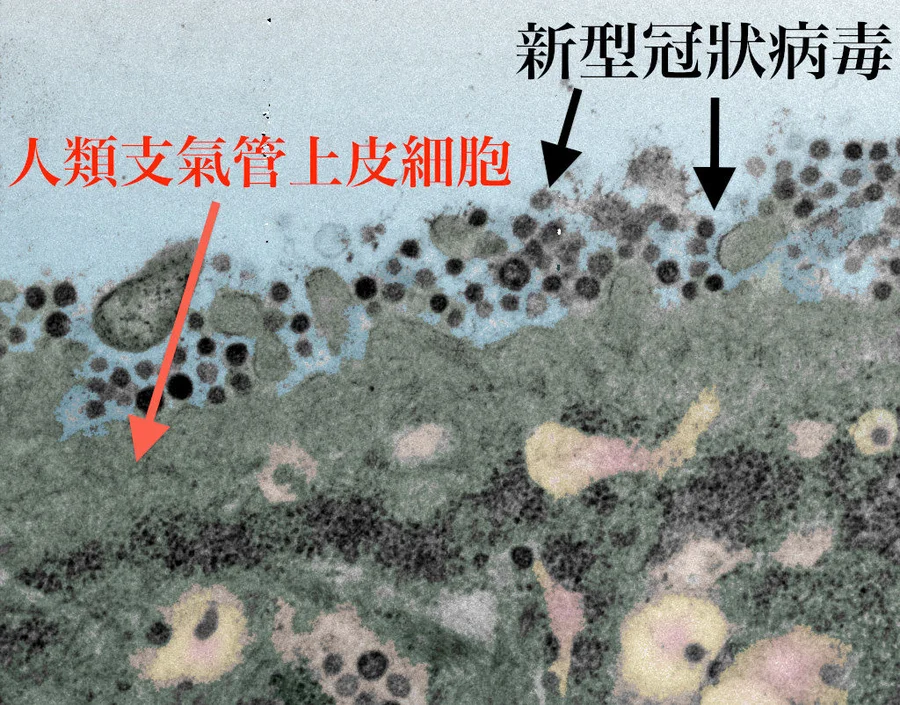 The University of Hong Kong Li Ka Shing Faculty of Medicine’s study finds that, novel coronavirus can infect the cells responsible for oxygen exchange in the lung.  It can also spread from the lung to other organs, and the rate of replication is much faster than SARS.